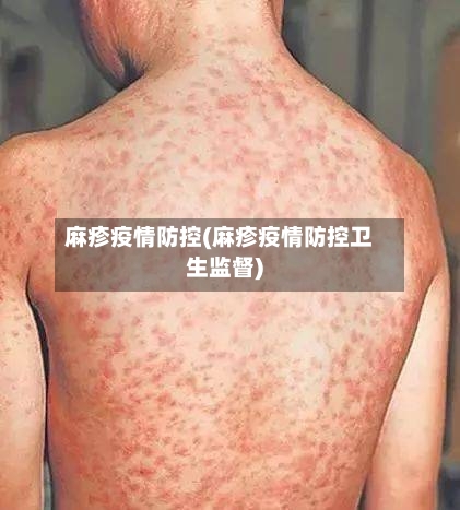 麻疹疫情防控(麻疹疫情防控卫生监督)